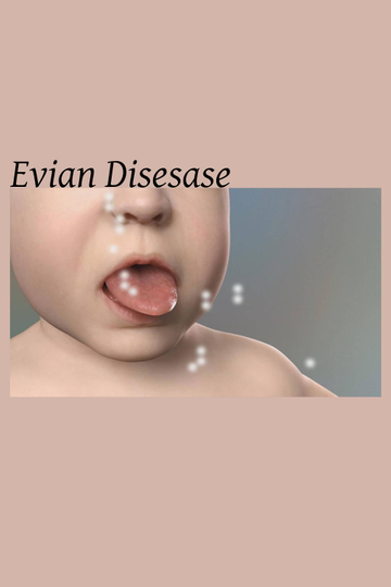 Evian Disesase