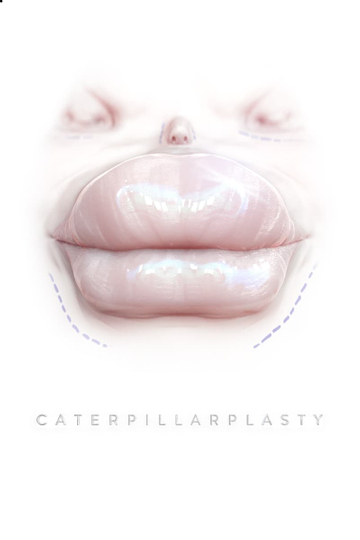 Caterpillarplasty