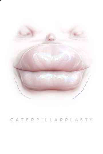 Caterpillarplasty
